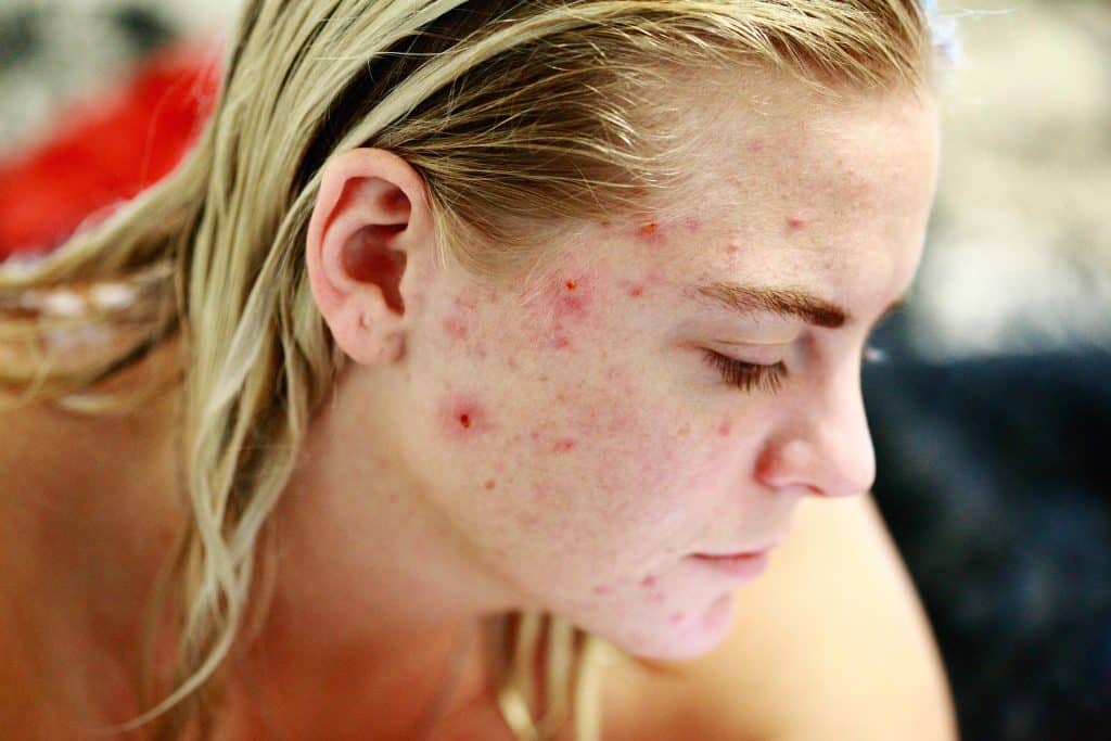 skincare products cause acne